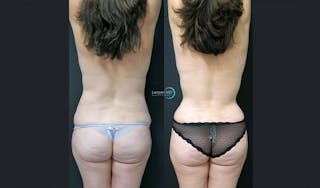 Love Handle Liposuction Before & After Gallery - Patient 289197 - Image 1