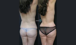 Love Handle Liposuction Before & After Gallery - Patient 289197 - Image 2