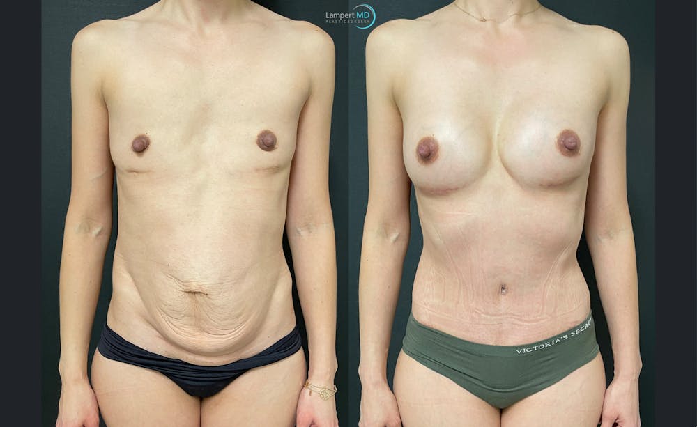 Mommy Makeover Before & After Gallery - Patient 143556257 - Image 1