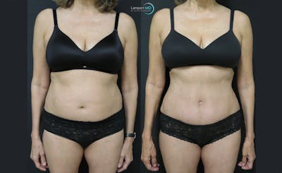 Mommy Makeover Before & After Gallery - Patient 143556261 - Image 1