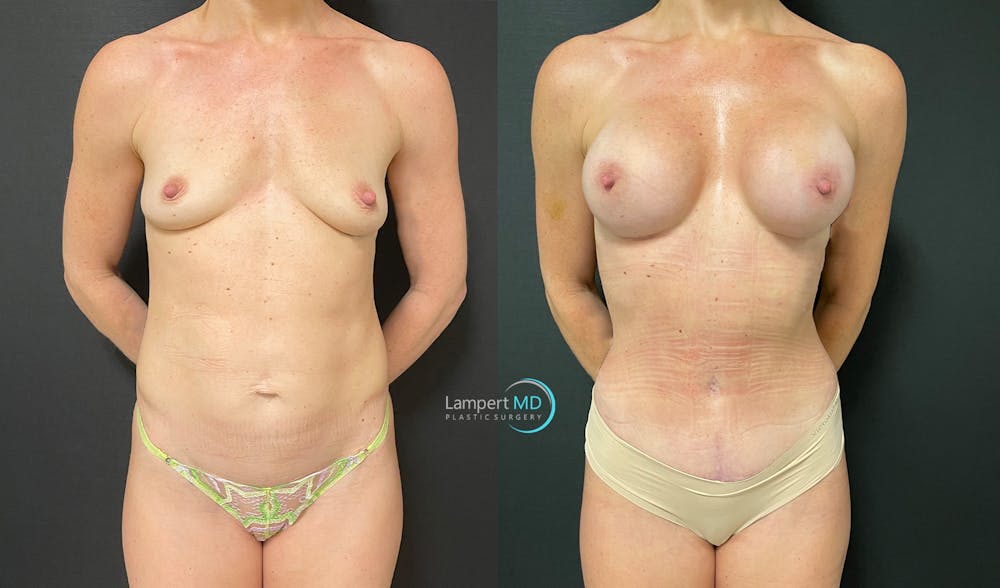 Mommy Makeover Before & After Gallery - Patient 143556262 - Image 1
