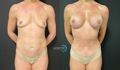 Mommy Makeover Before & After Gallery - Patient 143556262 - Image 1