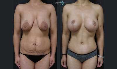 Mommy Makeover Before & After Gallery - Patient 143556269 - Image 1
