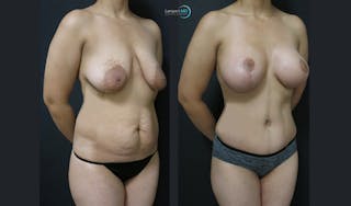 Mommy Makeover Before & After Gallery - Patient 143556269 - Image 2