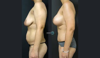 Mommy Makeover Before & After Gallery - Patient 143556269 - Image 3