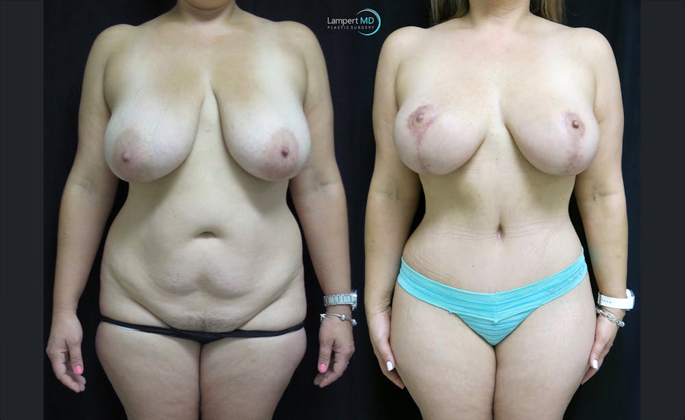 Mommy Makeover Before & After Gallery - Patient 143556271 - Image 1