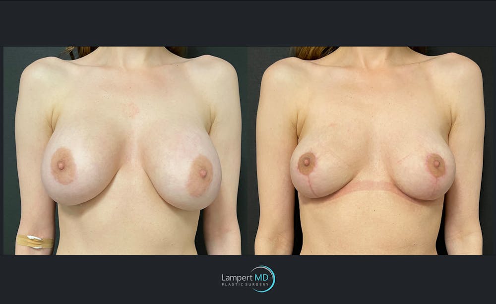 Breast Lift Before & After Gallery - Patient 143576121 - Image 1