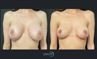 Breast Lift Before & After Gallery - Patient 143576121 - Image 1