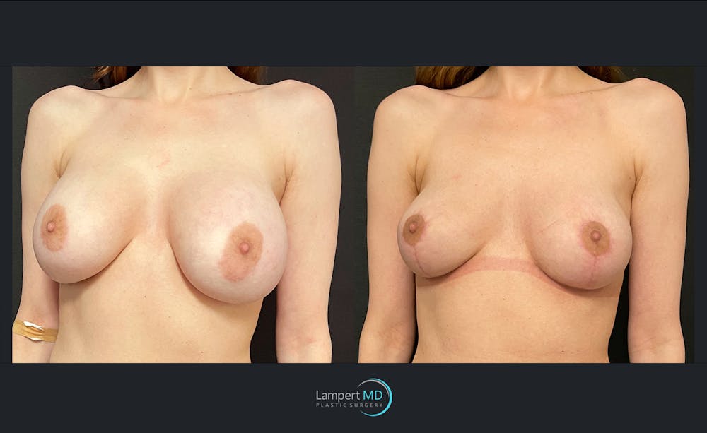 Breast Lift Before & After Gallery - Patient 143576121 - Image 2