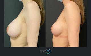 Breast Lift Before & After Gallery - Patient 143576121 - Image 3