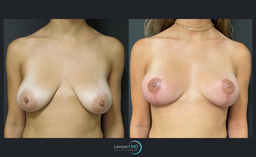 Breast Lift Before & After Gallery - Patient 143576120 - Image 1