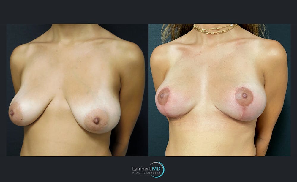 Breast Lift Before & After Gallery - Patient 151885232 - Image 2