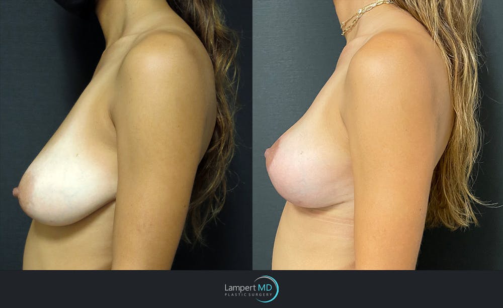 Breast Lift Before & After Gallery - Patient 143576120 - Image 3