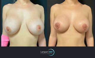 Breast Revision Before & After Gallery - Patient 144554866 - Image 1