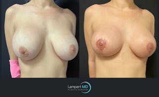 Breast Revision Before & After Gallery - Patient 144554866 - Image 2