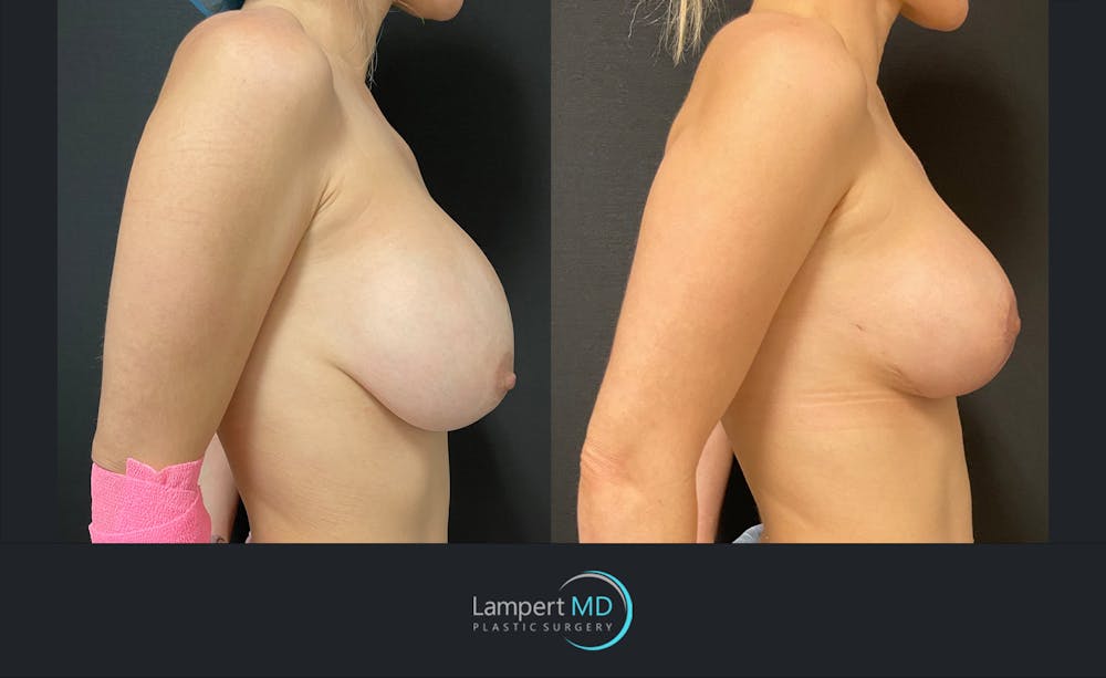 Breast Revision Before & After Gallery - Patient 144554866 - Image 3