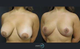 Breast Lift Before & After Gallery - Patient 143576301 - Image 2