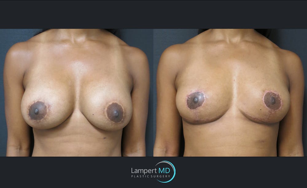 Breast Lift Before & After Gallery - Patient 143576343 - Image 1