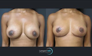 Breast Lift Before & After Gallery - Patient 143576343 - Image 1