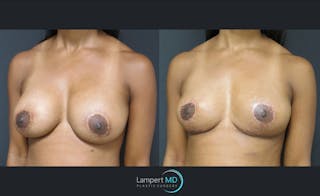 Breast Lift Before & After Gallery - Patient 143576343 - Image 2