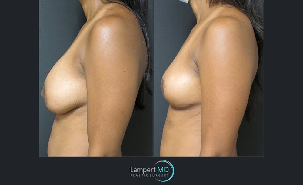 Breast Lift Before & After Gallery - Patient 143576343 - Image 3