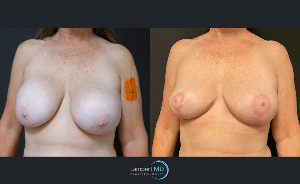 Breast Lift Before & After Gallery - Patient 143576355 - Image 2