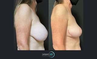 Breast Lift Before & After Gallery - Patient 143576355 - Image 3