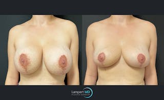 Breast Lift Before & After Gallery - Patient 143576375 - Image 1