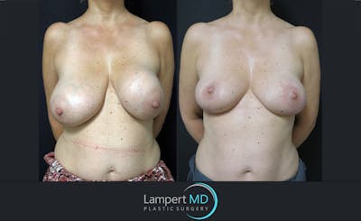 Breast Revision Before & After Gallery - Patient 398362 - Image 1