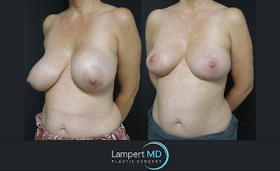 Breast Lift Before & After Gallery - Patient 143576394 - Image 2