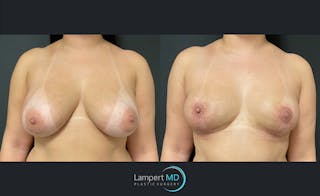 Breast Lift Before & After Gallery - Patient 143576400 - Image 1