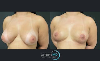 Breast Lift Before & After Gallery - Patient 143576400 - Image 2