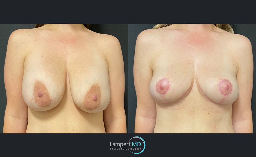 Breast Lift Before & After Gallery - Patient 143576410 - Image 1