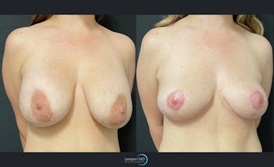 Breast Lift Before & After Gallery - Patient 143576410 - Image 2