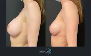 Breast Lift Before & After Gallery - Patient 143576410 - Image 3