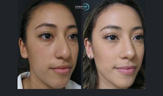 Rhinoplasty Before & After Gallery - Patient 123815980 - Image 2