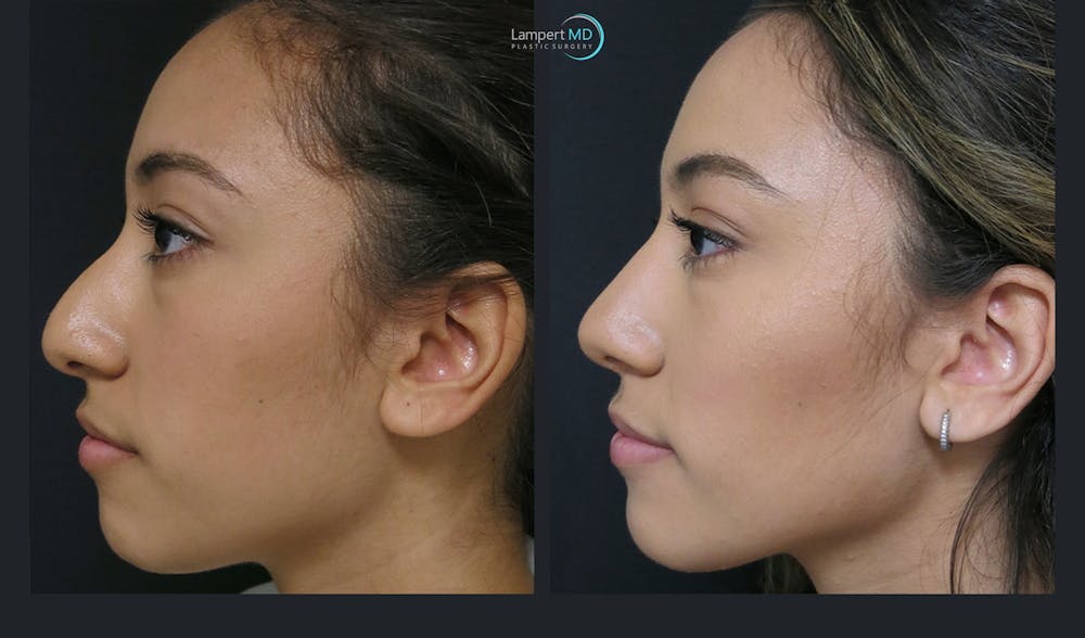 Rhinoplasty Before & After Gallery - Patient 123815980 - Image 3