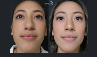 Rhinoplasty Before & After Gallery - Patient 123815980 - Image 4