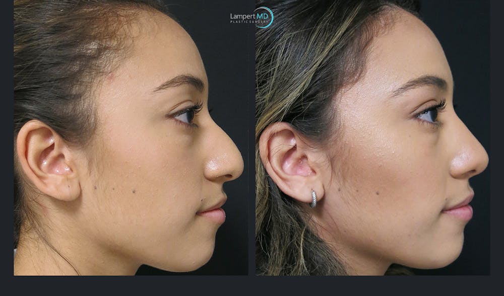 Rhinoplasty Before & After Gallery - Patient 123815980 - Image 5