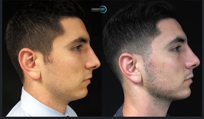 Rhinoplasty Before & After Gallery - Patient 123816183 - Image 1