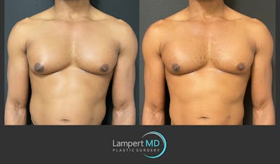 Gynecomastia Before & After Gallery - Patient 144405065 - Image 1