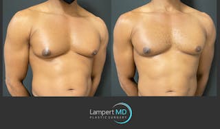 Gynecomastia Before & After Gallery - Patient 144405065 - Image 2