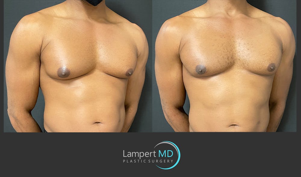 Gynecomastia Before & After Gallery - Patient 144405065 - Image 2