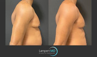 Gynecomastia Before & After Gallery - Patient 144405065 - Image 3