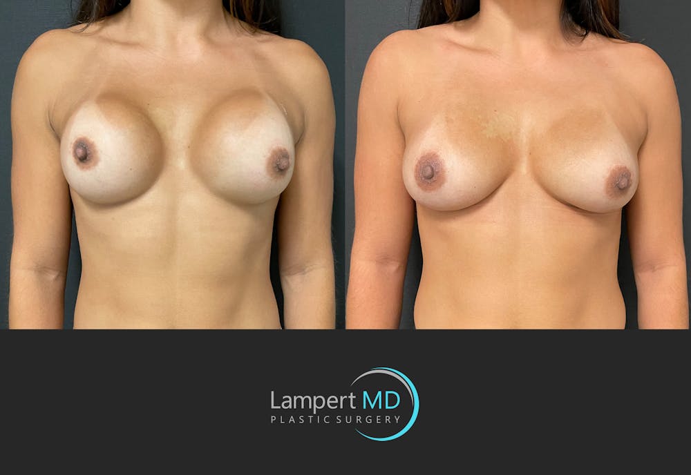 Breast Revision Before & After Gallery - Patient 144554870 - Image 1