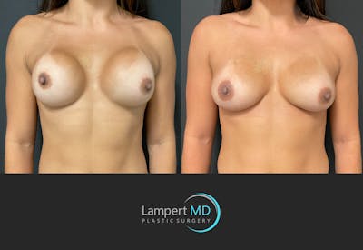 Breast Revision Before & After Gallery - Patient 144554870 - Image 1