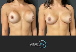 Breast Revision Before & After Gallery - Patient 144554870 - Image 2