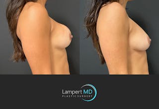 Breast Revision Before & After Gallery - Patient 144554870 - Image 3