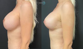 Breast Revision Before & After Gallery - Patient 144554871 - Image 3