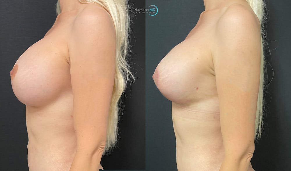 Breast Revision Before & After Gallery - Patient 144554871 - Image 2
